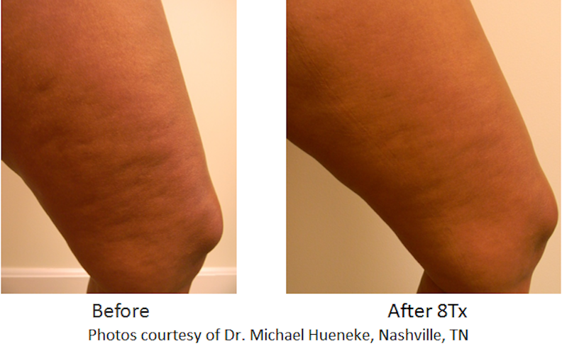 Cellulite Removal Before & After Photos